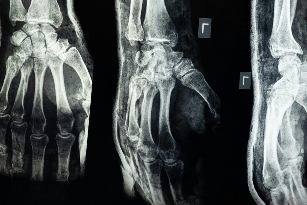 Close-up X-ray showing detailed view of human hand bones.